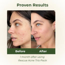 Botani Rescue Acne Trio Pack-3