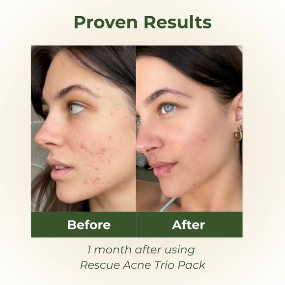 Botani Rescue Acne Trio Pack